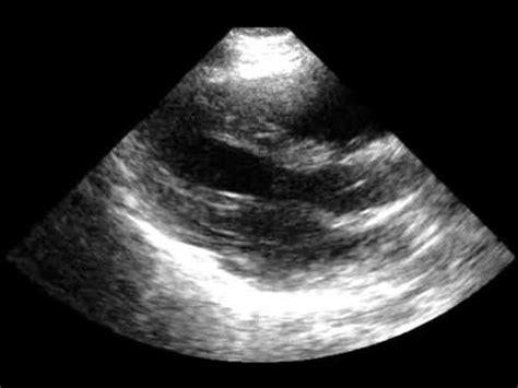 hyperdynamic heart syndrome in women.